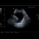Prostatic hyperplasia, trabecular hypertrophy of urinary bladder: US - Ultrasound